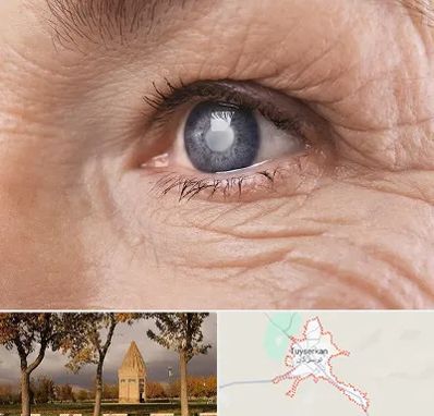 متخصص آب مروارید در تویسرکان