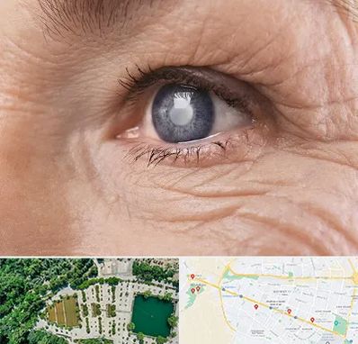 متخصص آب مروارید در وکیل آباد مشهد