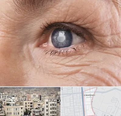 متخصص آب مروارید در اسکندری