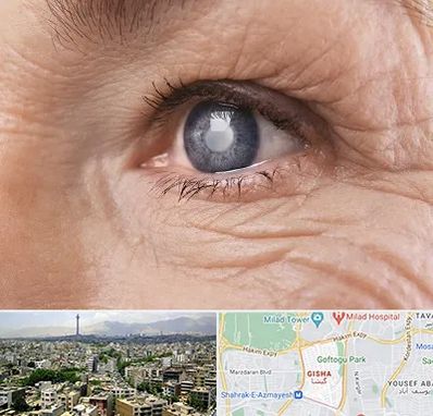 متخصص آب مروارید در گیشا