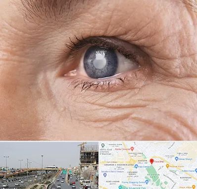 متخصص آب مروارید در بلوار توس مشهد