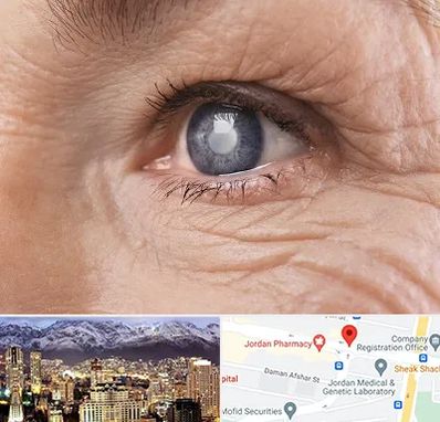 متخصص آب مروارید در جردن