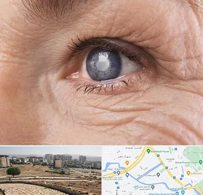 متخصص آب مروارید در کوی وحدت شیراز