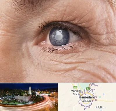 متخصص آب مروارید در همدان