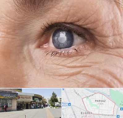 متخصص آب مروارید در پرواز تبریز