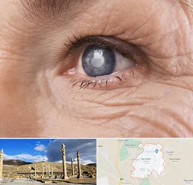 متخصص آب مروارید در مرودشت