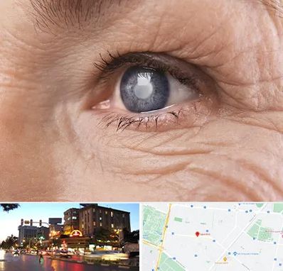 متخصص آب مروارید در بلوار سجاد مشهد