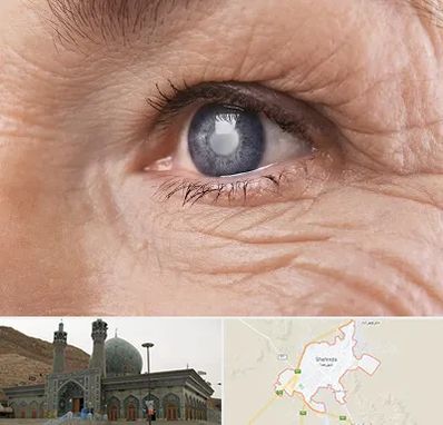 متخصص آب مروارید در شهرضا