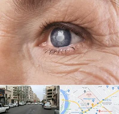 متخصص آب مروارید در زیتون کارمندی اهواز