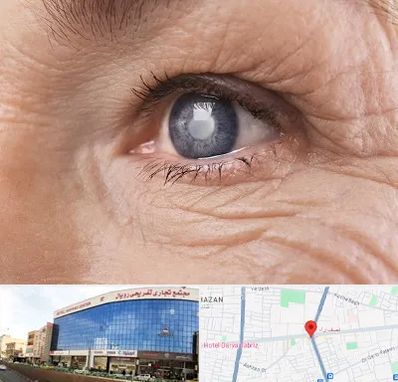 متخصص آب مروارید در نصف راه تبریز