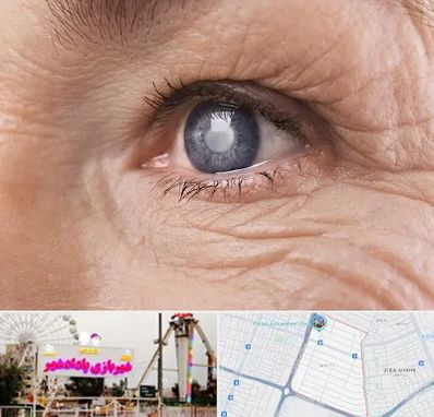 متخصص آب مروارید در پادادشهر اهواز