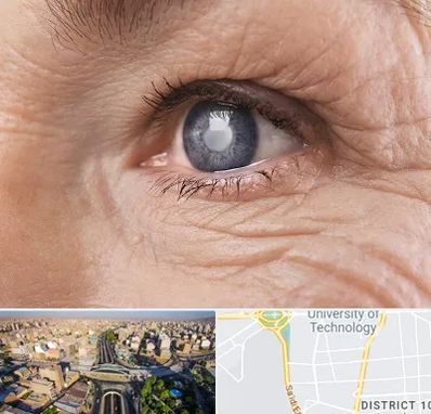 متخصص آب مروارید در استاد معین