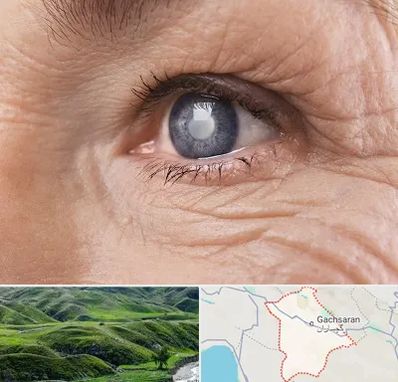متخصص آب مروارید در گچساران