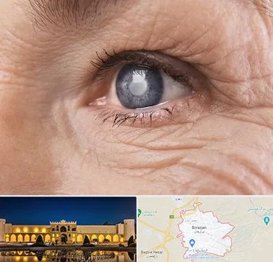 متخصص آب مروارید در برازجان