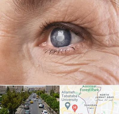 متخصص آب مروارید در شهران