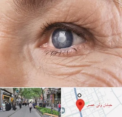 متخصص آب مروارید در ولیعصر شهریار