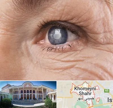 متخصص آب مروارید در خمینی شهر