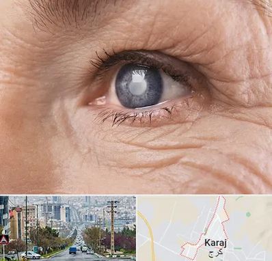 متخصص آب مروارید در گوهردشت کرج