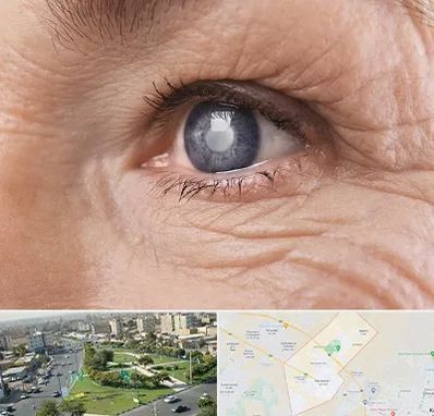 متخصص آب مروارید در کمال شهر کرج