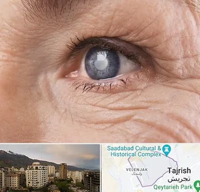 متخصص آب مروارید در زعفرانیه