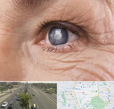 متخصص آب مروارید در منطقه 17 تهران