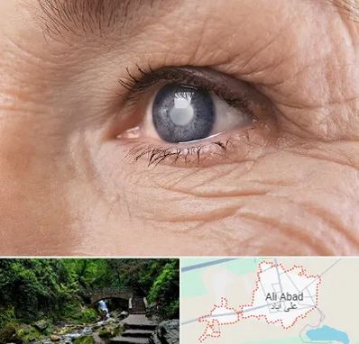 متخصص آب مروارید در علی آباد کتول