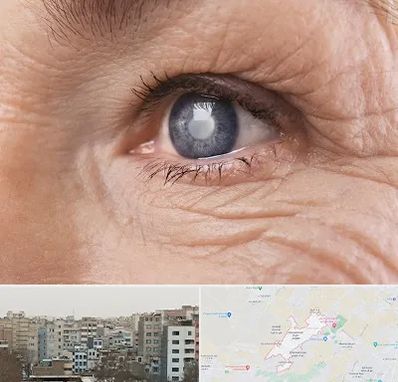 متخصص آب مروارید در محمد شهر کرج