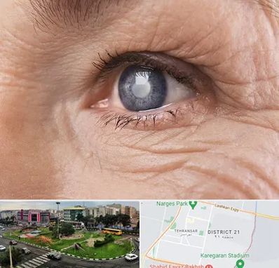 متخصص آب مروارید در تهرانسر