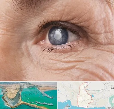 متخصص آب مروارید در سیستان و بلوچستان