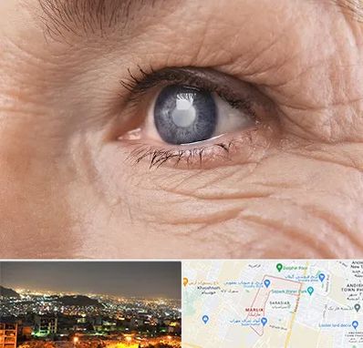 متخصص آب مروارید در مارلیک کرج