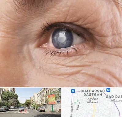 متخصص آب مروارید در چهارصد دستگاه