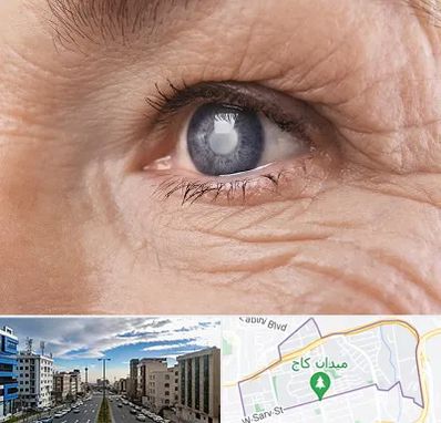 متخصص آب مروارید در سعادت آباد