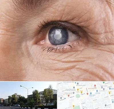 متخصص آب مروارید در میدان کاج