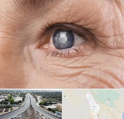 متخصص آب مروارید در اندیمشک