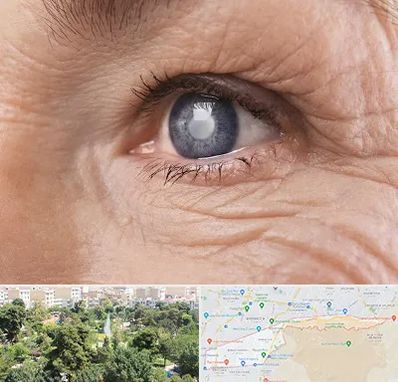 متخصص آب مروارید در منطقه 13 تهران