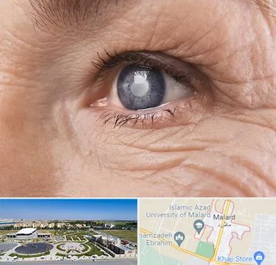 متخصص آب مروارید در ملارد