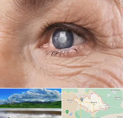 متخصص آب مروارید در مرند