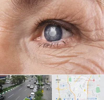 متخصص آب مروارید در ستارخان