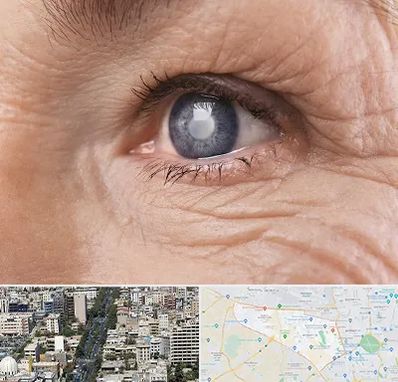 متخصص آب مروارید در منطقه 18 تهران