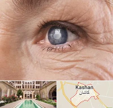متخصص آب مروارید در کاشان