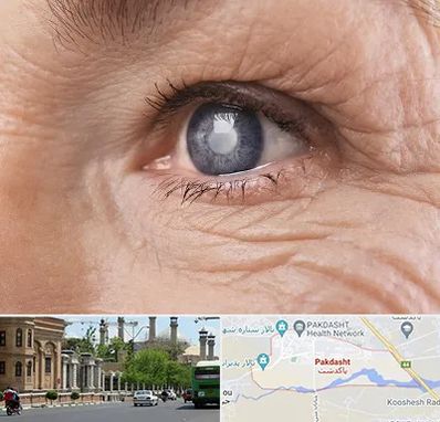 متخصص آب مروارید در پاکدشت