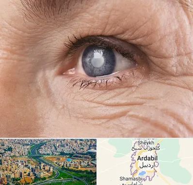 متخصص آب مروارید در اردبیل