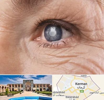 متخصص آب مروارید در کرمان