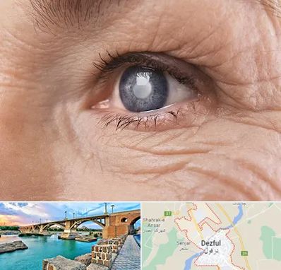 متخصص آب مروارید در دزفول