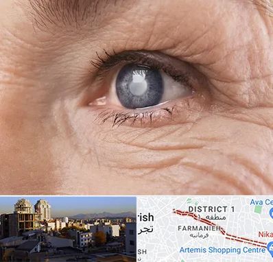 متخصص آب مروارید در فرمانیه