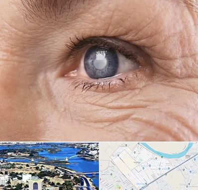 متخصص آب مروارید در کوروش اهواز