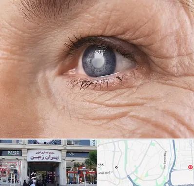 متخصص آب مروارید در ایران زمین