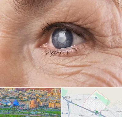 متخصص آب مروارید در رشدیه تبریز