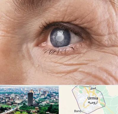 متخصص آب مروارید در ارومیه