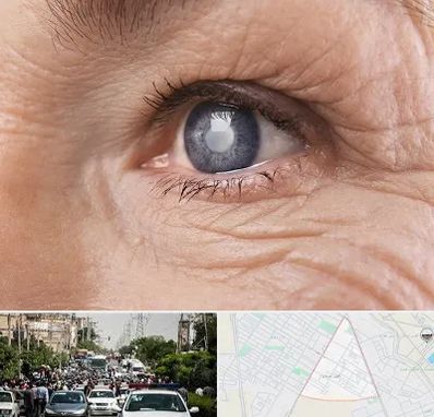 متخصص آب مروارید در سیدی مشهد